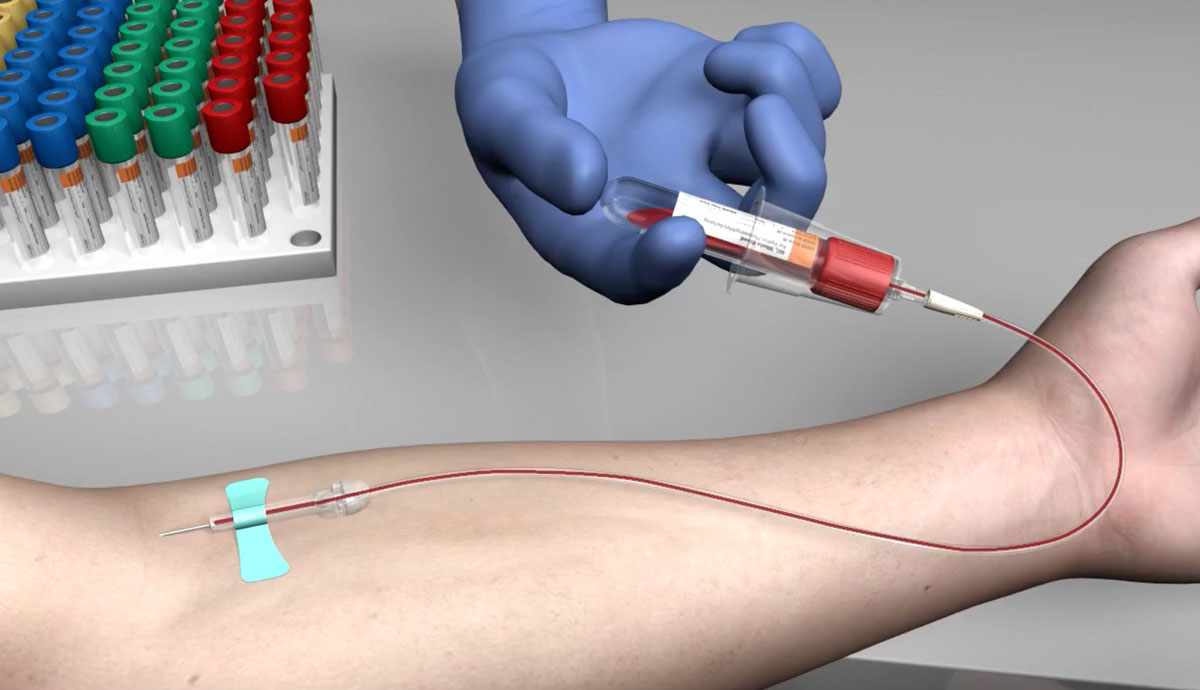PRP-Injection-Pattaya-Bangkok-Thailand PRP-Injection-Pattaya-Bangkok-Thailand